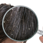 Tips Menghilangkan Ketombe Rambut dengan Alami