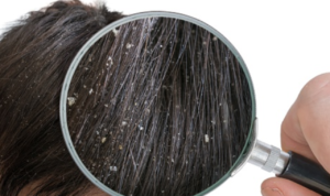 Tips Menghilangkan Ketombe Rambut dengan Alami