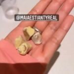 Penampakan 5 Batu Empedu di Tubuh Maia Estianty