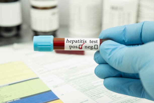 Pasien Diduga Penyakit Hepatitis Misterius Ditemukan di Bekasi