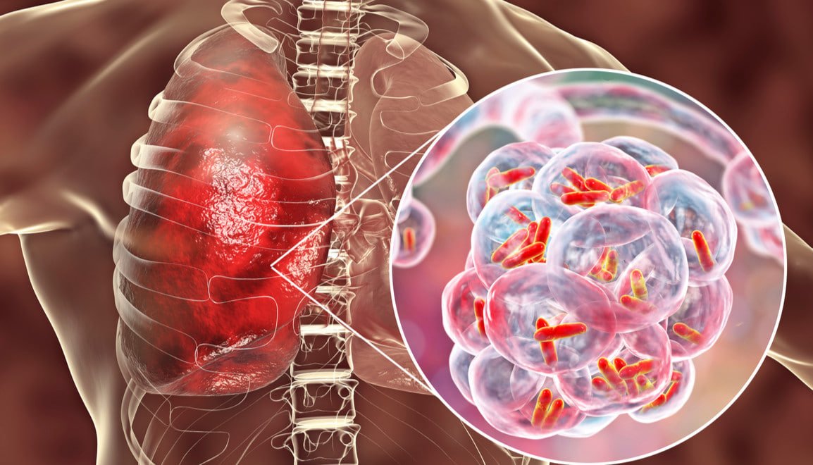 Foto: Ilustrasi Penyakit Pneumonia (Sumber: istimewa)
