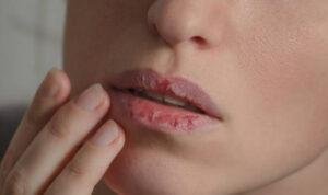 Bibir Kering dan Pecah-pecah, Ini Solusinya