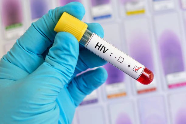 Foto: Ilustrasi HIV/AIDS (Sumber: istock)