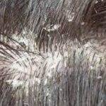 8 Cara Atasi Rambut Berketombe