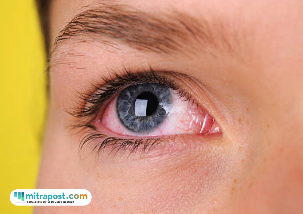 Tips Rumahan Mengatasi Mata Merah