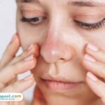 Tips Meminimalkan Efek Purging Setelah Menggunakan Skincare Baru