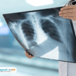 Ilustrasi Paru-Paru Bagaimana Cara Menjaga Kesehatan Paru-Paru dalam Aktivitas Harian?