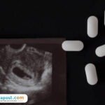 Ilustrasi pil aborsi/istock Ilustrasi pil aborsi/istock Mahasiswi Aborsi