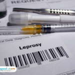 Dua WNI di Rumania Dikonfirmasi Kusta, Kasus Pertama Setelah Lebih dari 40 Tahun