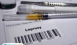 Dua WNI di Rumania Dikonfirmasi Kusta, Kasus Pertama Setelah Lebih dari 40 Tahun