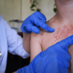 Kasus Campak di Cirebon Berstatus KLB: 150 Warga Suspek dan 9 Dinyatakan Positif