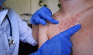 Ilustrasi kasus Campak/istock