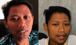 Edi Utomo, Pemuda 26 Tahun yang Sudah Cuci Darah 700 Kali Akibat Gagal Ginjal Kronis